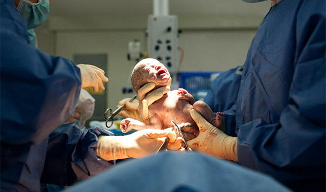 Caesarean baby