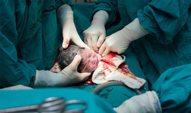 Cesarean delivery