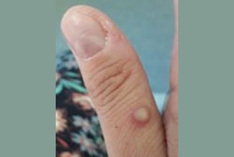 Kerala Monkeypox