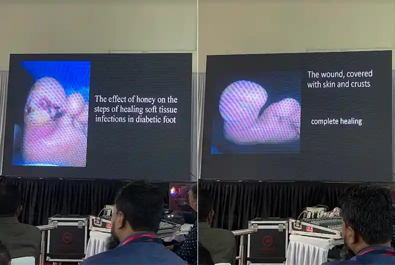 Tibbe Nabawi Conference: Honey powerful healer, also for diabetic foot